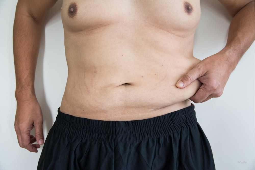 Male Tummy Tuck  Abdominoplasty  El Paso  Juarez