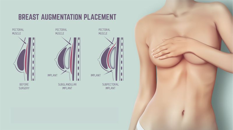 The Latest Mentor Breast Implants, And How To Avoid Dimples And Rippli –  Eunogo